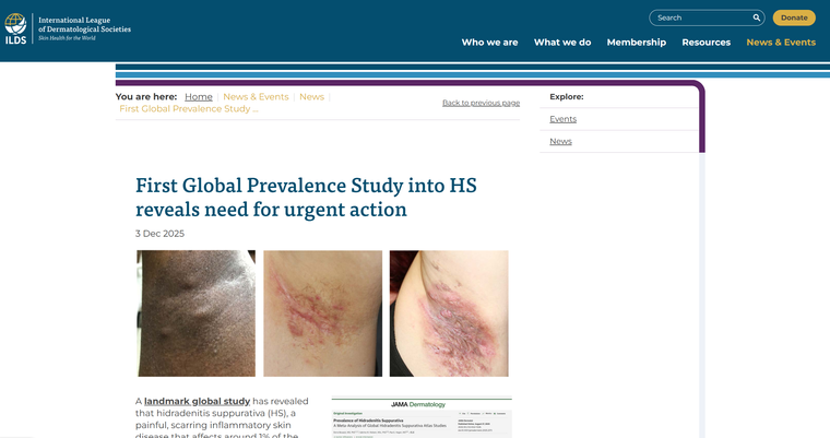 First Global Prevalence Study into HS reveals need for urgent action